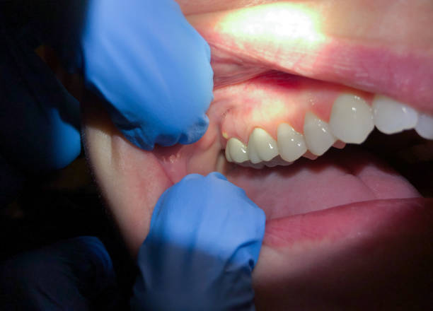 Best Emergency Root Canal Treatment in Sherrill, NY